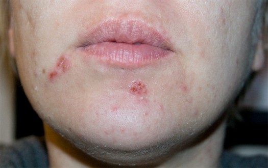 badskin
