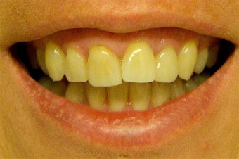 vitare tänder kol